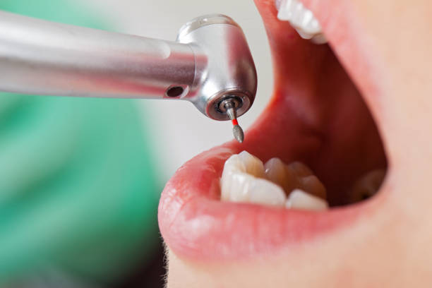 Best Emergency Treatment for Dental Infections or Abscesses in Arapahoe, WY